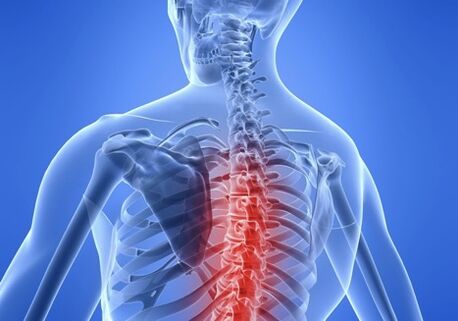 osteocondrose da columna vertebral torácica