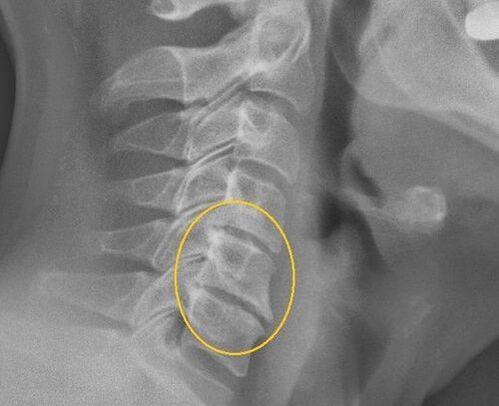 Osteocondrose da columna cervical nun x -ray