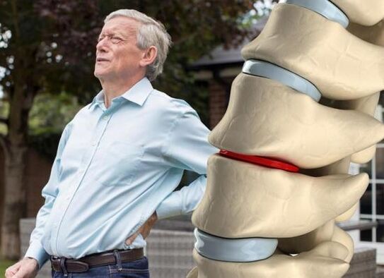A osteocondrose afecta os discos intervertebrais e causa dor nas costas