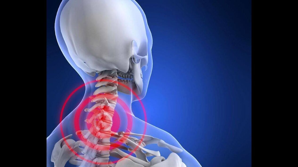 Osteocondrose da columna cervical